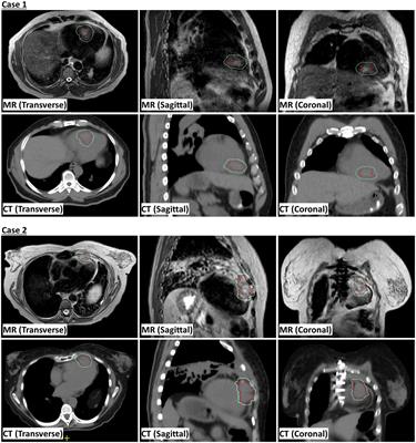 Case report: Cardiac neuroendocrine carcinoma and squamous cell carcinoma treated with MR-guided adaptive stereotactic radiation therapy